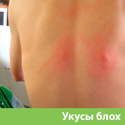 Укусы блох в Дмитрове