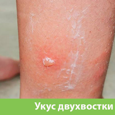 Укус двухвостки в Дмитрове