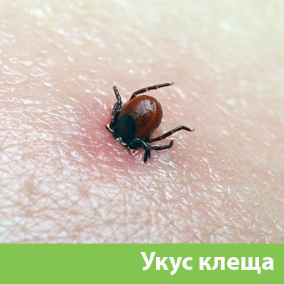 Укус клеща в Дмитрове