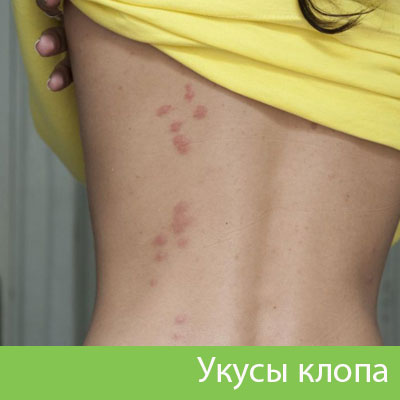 Профессиональное уничтожение клопов в Дмитрове